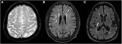 Increased Levels of Circulating Angiogenic Cells and Signaling Proteins in Older Adults With Cerebral Small Vessel Disease